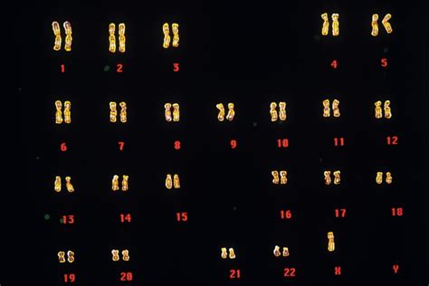 Turner S Syndrome Karyotype Photograph By Gjlp Science Photo Library