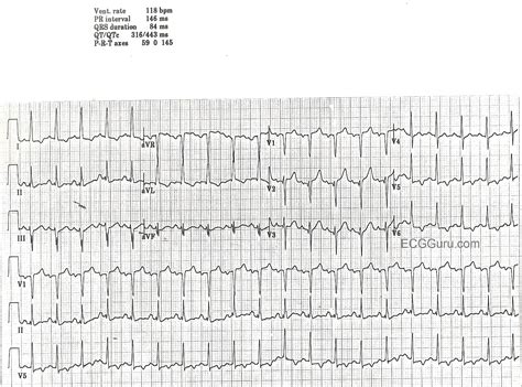 Ischemia occurs when part of the heart muscle, the myocardium, is deprived of oxygen and nutrients. Coronary Artery Disease | ECG Guru - Instructor Resources