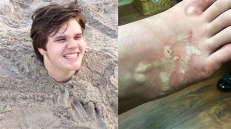 Teen Infected With Hookworms On Florida Beach