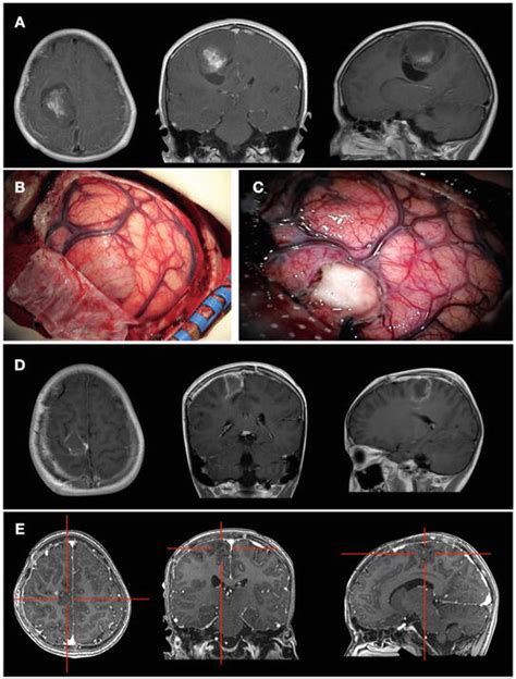 Awake Craniotomy And Brain Mapping For Brain Tumor Resection In