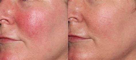 Ipl Laser For Rosacea Cosmetic Surgery Tips