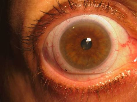 Keratoconus Eye Doctor In Baltimore Book An Eye Exam Online