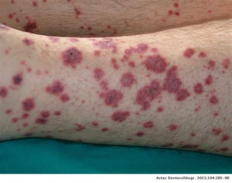 Cutaneous Alerts In Systemic Malignancy Part I Actas Dermo