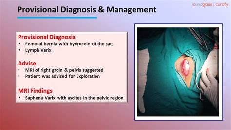 A Clinical Case Of Hydrocele Of The Femoral Hernial Sac