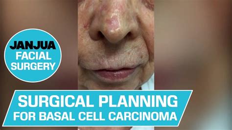 Basal Cell Carcinoma Of The Outer Nose Overview On Surgical Techniques