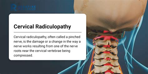 Cervical Radiculopathy Njs Top Orthopedic Spine And Pain Management Center