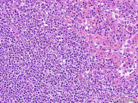 Leukemia and lymphoma are both forms of blood cancer, but they affect the body in different ways. Lymphoma of Colon and Rectum