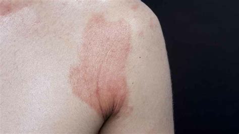 How To Identify A Skin Rash The Key To Healthy Living