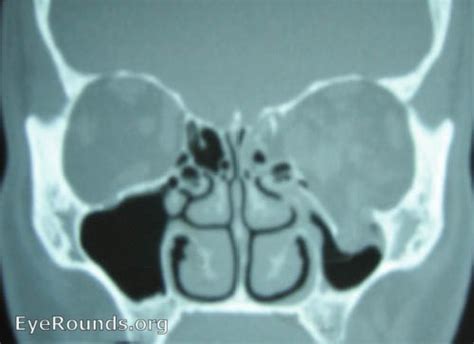 Medial wall and orbital floor blowout fractures, left ...