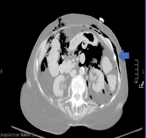 Cureus Pelvic Rectal Stercoral Perforation Resulting In Diffuse