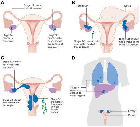 Ovarian Cancer Basics Clearity Foundation