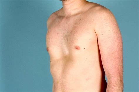 Pectus Excavatum qué es síntomas y tratamiento Top Doctors