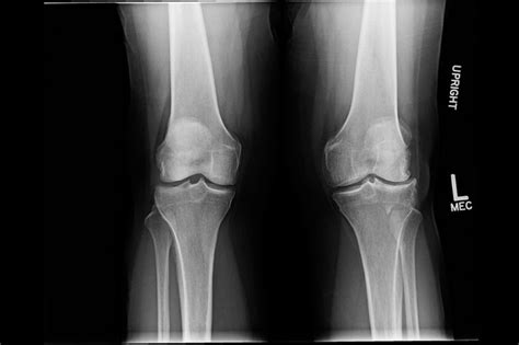 Ortho Dx Arthritis Of The Knee Clinical Advisor