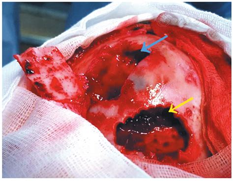 Supra And Infra Tentorial Subacute Extradural Hematoma Chinese