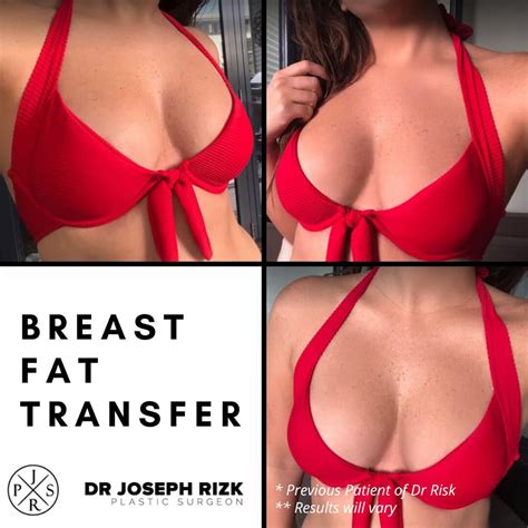 Everything You Need To Know About Breast Fat Transfer Augmentation