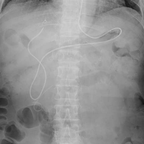 An Endoscopic Nasobiliary Drainage Tube Has Been Placed Download