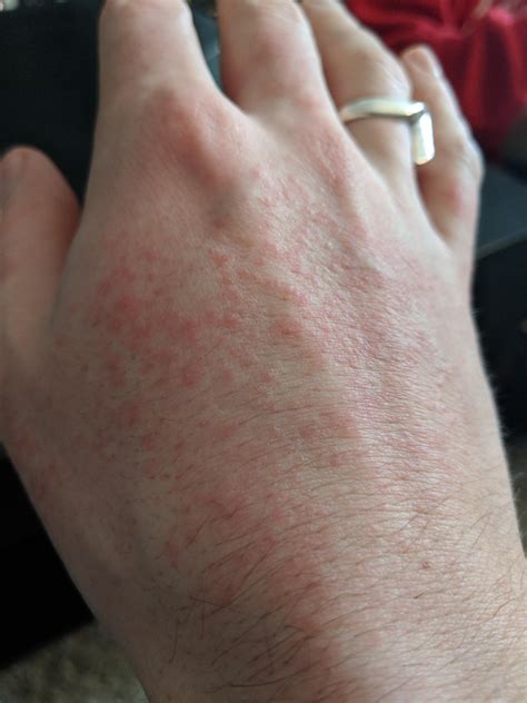 What Could This Rash Be Caused By Thebrewery