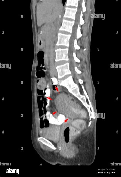 Rectal Cancer Ct Scan Stock Photo Alamy