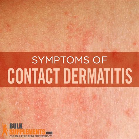 Contact Dermatitis Symptoms Causes Treatment Artofit