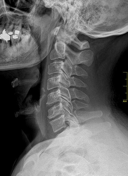 Radiologia Aprenda Bater Radiografia Do Coluna Cervical Ap Ou Pa E Perfil