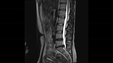 Grade 1 and 2 are very well managed with the conservative trial with some sort of medicines and physiotherapy. Lumbar Spine: L4 Lumbar Spine