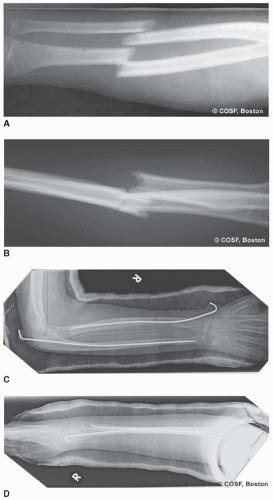 Operative Treatment Of Pediatric Forearm Fractures Using Flexible Im