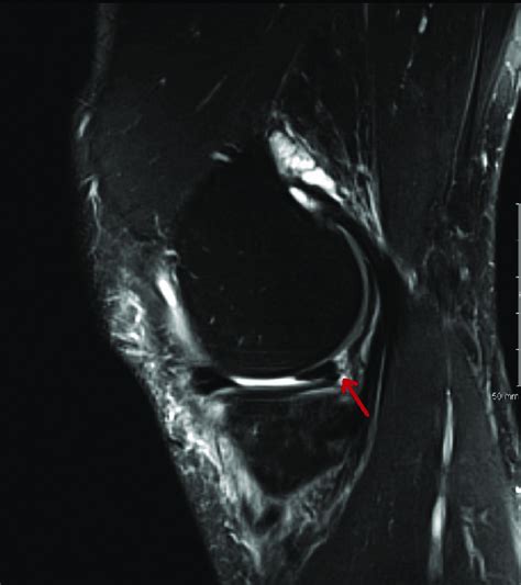 Sagittal T2 Weighted Magnetic Resonance Image Of A Right Knee Showing