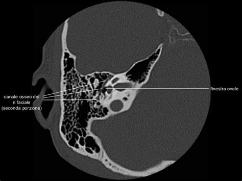 Anatomia Rocca TC - CT temporal bone anatomy