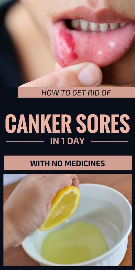 Canker Sore Is A Condition That Causes Small Painful Ulcers In The