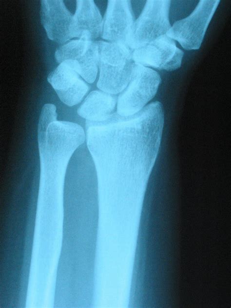 Unicameral Bone Cyst Of The Lunate In An Adult Case Report Journal
