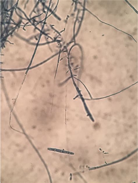 Scielo Brasil A Case Of Blepharitis Caused By Trichophyton Rubrum A