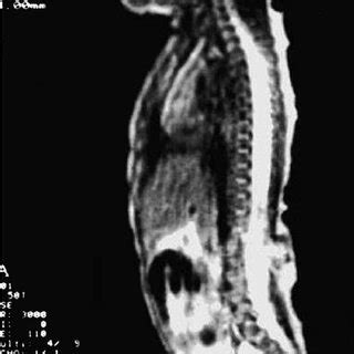T Weighted Sagittal Magnetic Resonance Imaging Scan Of The Lumbar My XXX Hot Girl