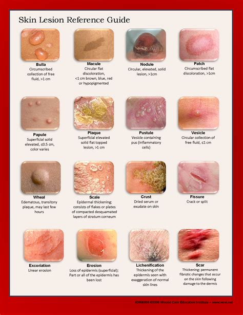 Image Result For Skin Lesion Guide Dermatology Nurse Home Health