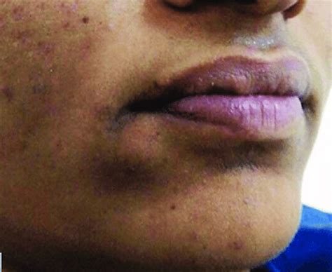 Lower Lips Swollen Lipstutorial Org