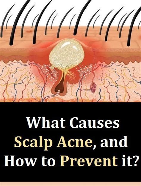 Scalp Pimples What Causes Them And How To Treat Them Pimples On