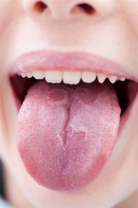 Psoriasis On The Tongue Symptoms Treatment And Prevention