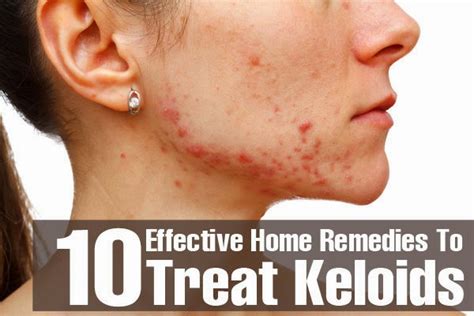 Top 10 Effective Home Remedies To Treat Keloids ~ Mzizi Mkavu