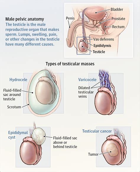 Testicular Mass Medical Anatomy Medical