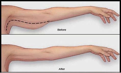 Arm Before And After Lake Diary