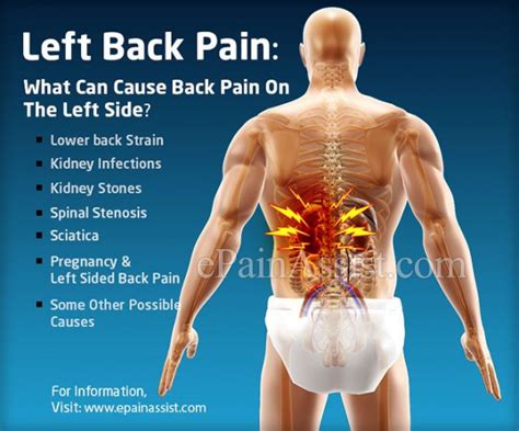 Kidney Infection Left Side Back Pain Kidrizi