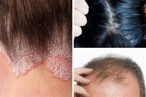 Doenças no couro cabeludo conheça as mais comuns