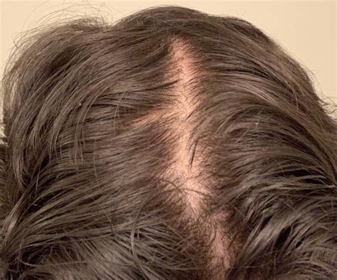 Since I got dandruff, I have been noticing my scalp is more visible. I ...