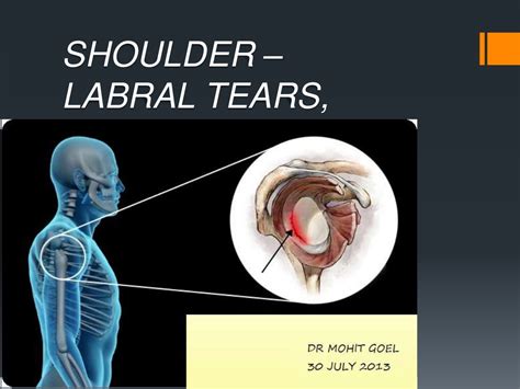 Shoulder Labral Tears Mri