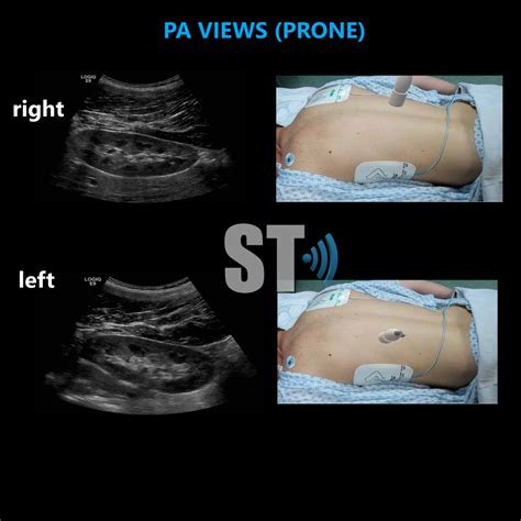 Renal Ultrasound Complete Protocol Sonographic Tendencies