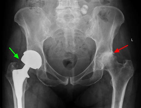 Hip Replacement Surgery Recovery Time Alternatives Risks