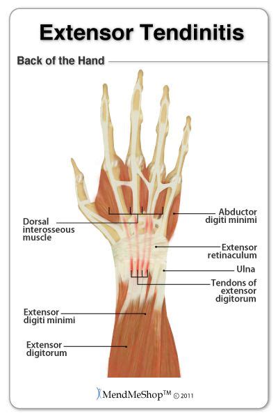 Extensor Tendonitis Of The Wrist Extensor Tendonitis Tendinitis