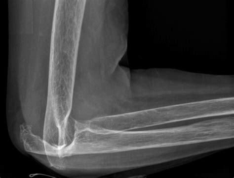 Rheumatoid Arthritis Elbow Radiology At St Vincents University