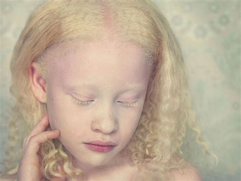 Albinismo é Uma Doença
