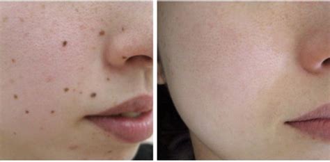 Cosmetic Mole Removal San Diego Skin Tags And Wart Removal Services