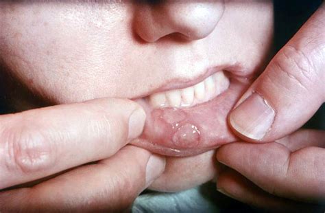 Canker Sore On Lip My Canker Sore Treatment